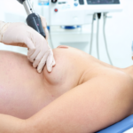 découvrez les risques et précautions essentielles à connaître sur l'épilation au laser pendant la grossesse pour assurer votre sécurité et celle de votre bébé.